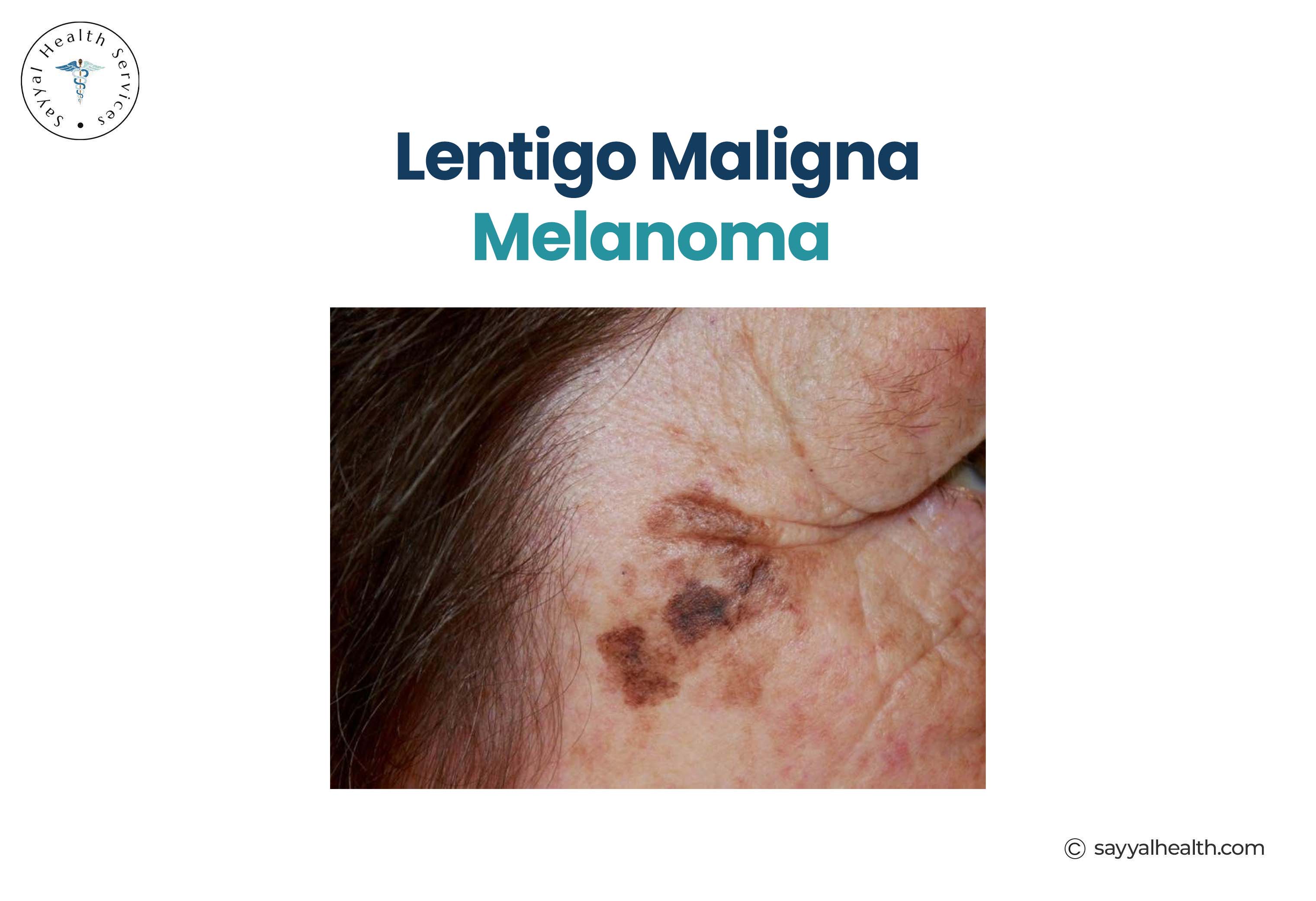picture of lentigo maligna melanoma on the face